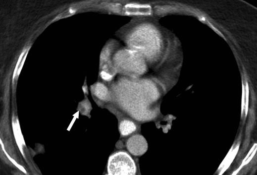 basis of the staging CT findings of a DVT and a Fig.