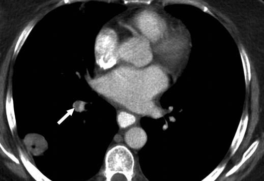 A, CT image shows right iliofemoral deep vein thrombosis (arrow).
