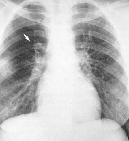 Companion Patient #2: Westermark Sign on CXR Watermark Sign: Dilatation of pulmonary vessels proximal to embolism along with collapse of distal vessels, often with a