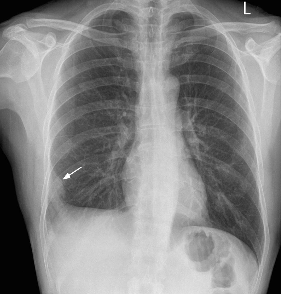 Hapmton s Hump: Peripheral wedge shaped opacity representing pulmonary infarction and atelectasis secondary to a pulmonary embolus as