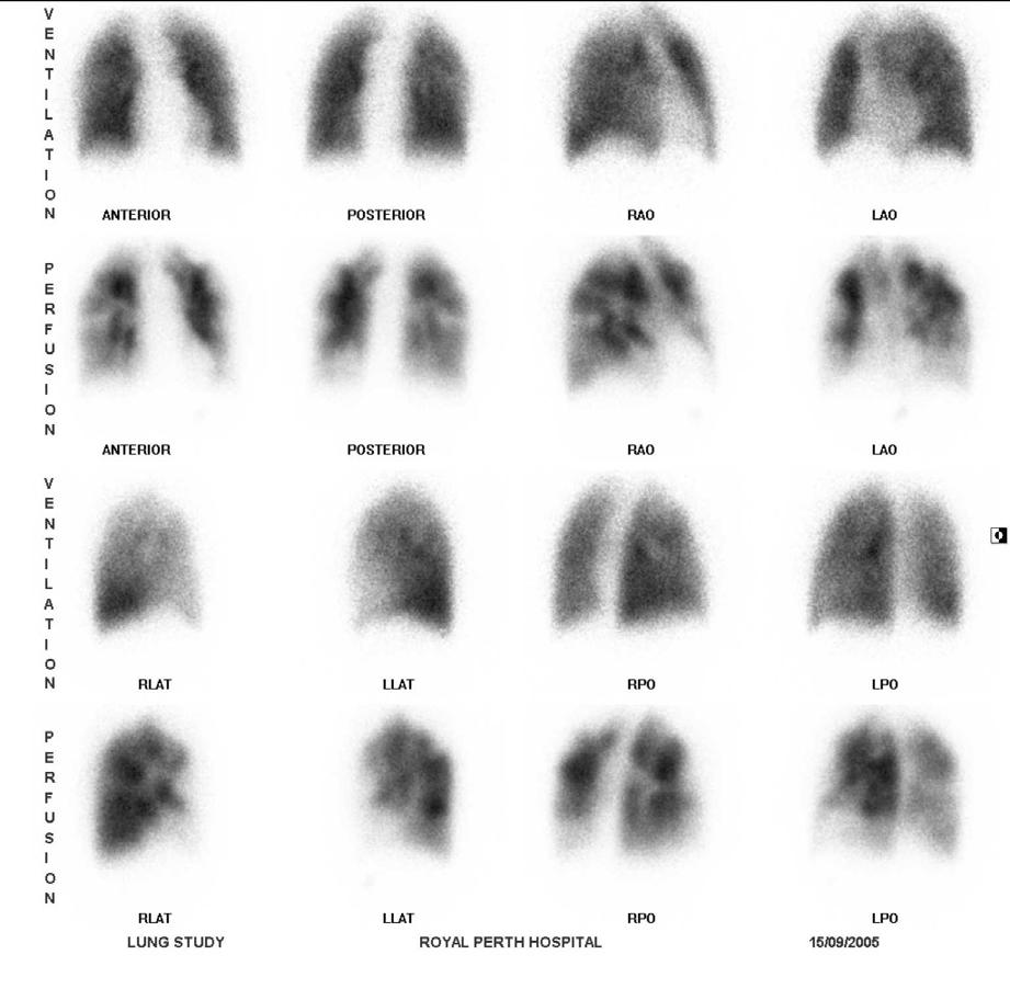 Companion Patient #4 with Abnormal VQ scan The ventilation series demonstrates uniform distribution of tracer throughout both lung fields.
