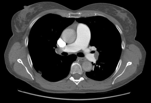 Our patient: Enlargement of Pulmonary Artery to 3.3 cm 33.