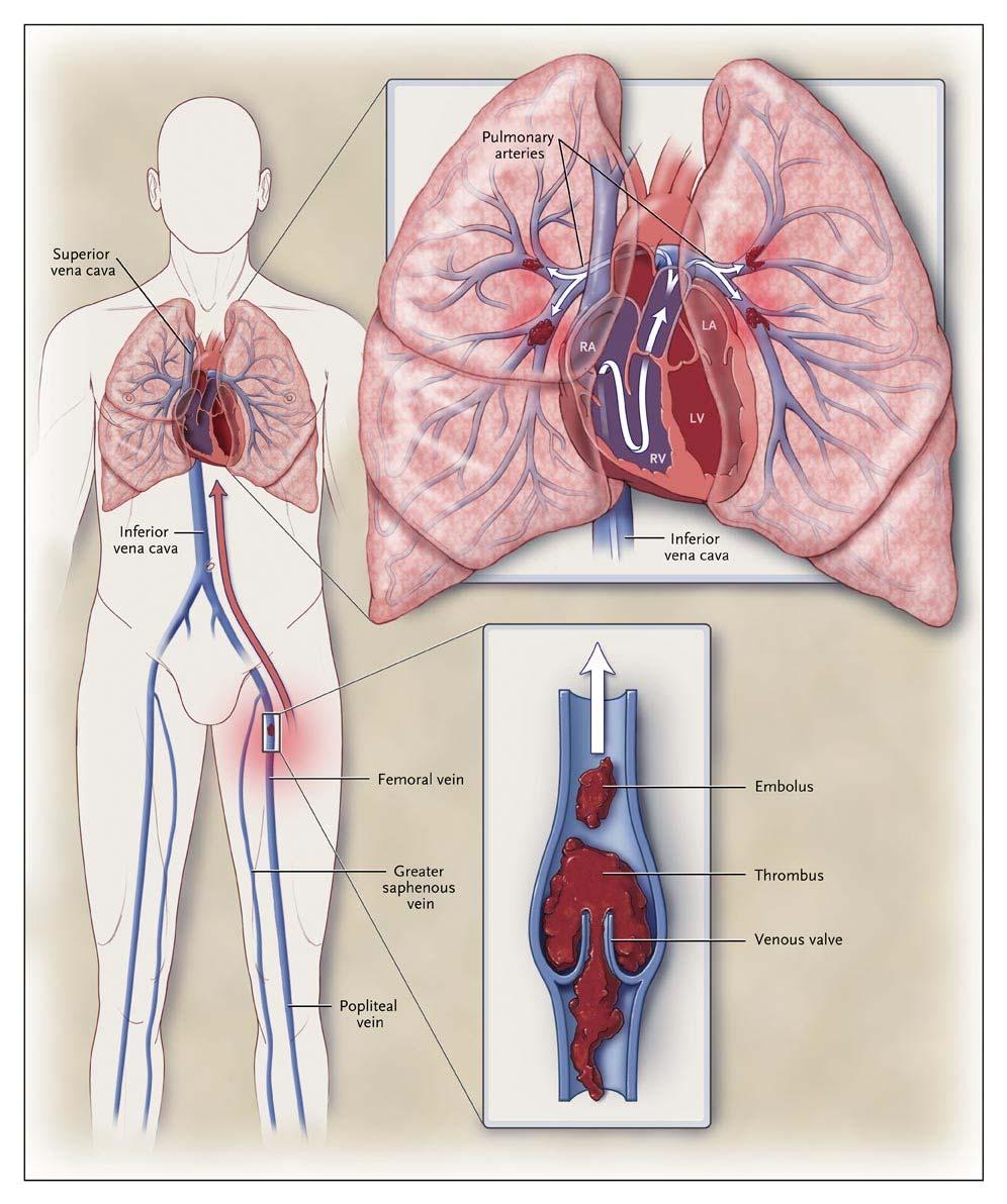 Diagrammatic Depiction of PE Pathophysiology Origin: Deep veins, most commonly the calf veins Develop in places of venous stasis e.g. venous valve pockets of lower extremity veins Risk of embolism is increased if clot propagates to or originates in popliteal veins or more proximally Tapson V.