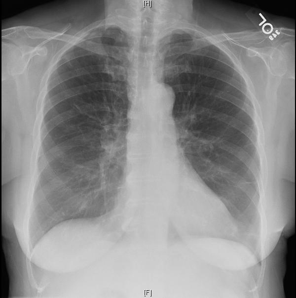 Companion Patient #1: CXR with Discoid Atelectasis CXR in a patient with a PE showing some areas of discoid atelectasis This does not