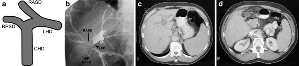 530 Insights Imaging (2011) 2:525 531 Fig. 7 a d A patient with left lobe and right anterior segmental atrophy associated with cholangiocarcinoma.