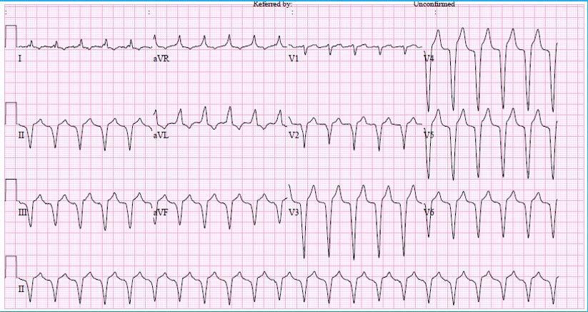 Arrhythmia 2015;16(3):173-177 Figure 2. Newly developed tachycardia. PVB PVARP Figure 3.