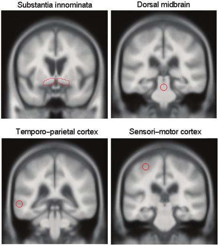 MRI patterns of atrophy in DLB and AD Brain (2007), 130, 708 ^719 711 Fig.
