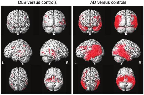 712 Brain (2007), 130,708^719 J.L.Whitwellet al. Table 1 Patient characteristics at the time of the MRI scan DLB (n ¼ 73) Alzheimer s disease (n ¼ 73) Controls (n ¼ 73) P-value* No.offemales(%) 17(23.