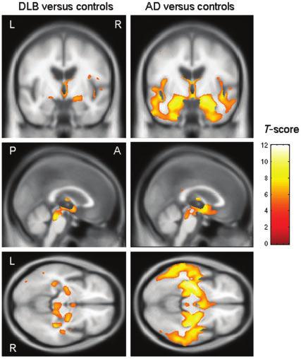MRI patterns of atrophy in DLB and AD Brain (2007), 130, 708 ^719 713 GM loss was identified throughout the temporal lobes, the posterior cingulate, insula and the inferior and middle frontal gyri.
