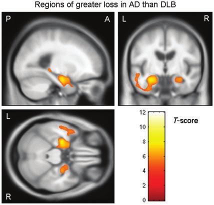 widespread pattern of loss (Fig. 3). Regions of GM loss were also identified around the lateral and third ventricles.