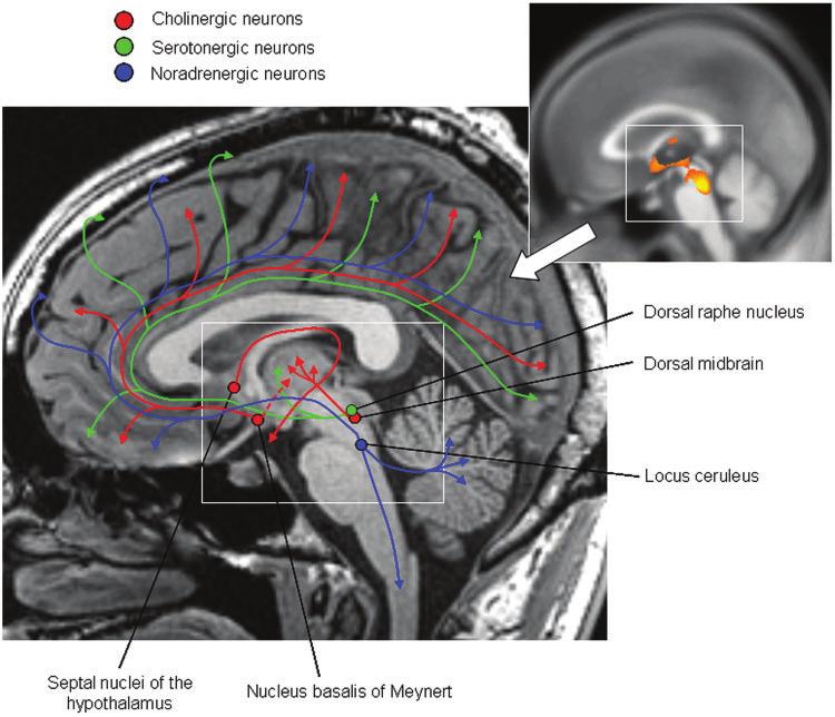 MRI patterns of atrophy in DLB and AD Brain (2007), 130, 708 ^719 715 GM loss in the SI was identified both on the VBM analysis and in the ROI measurements.