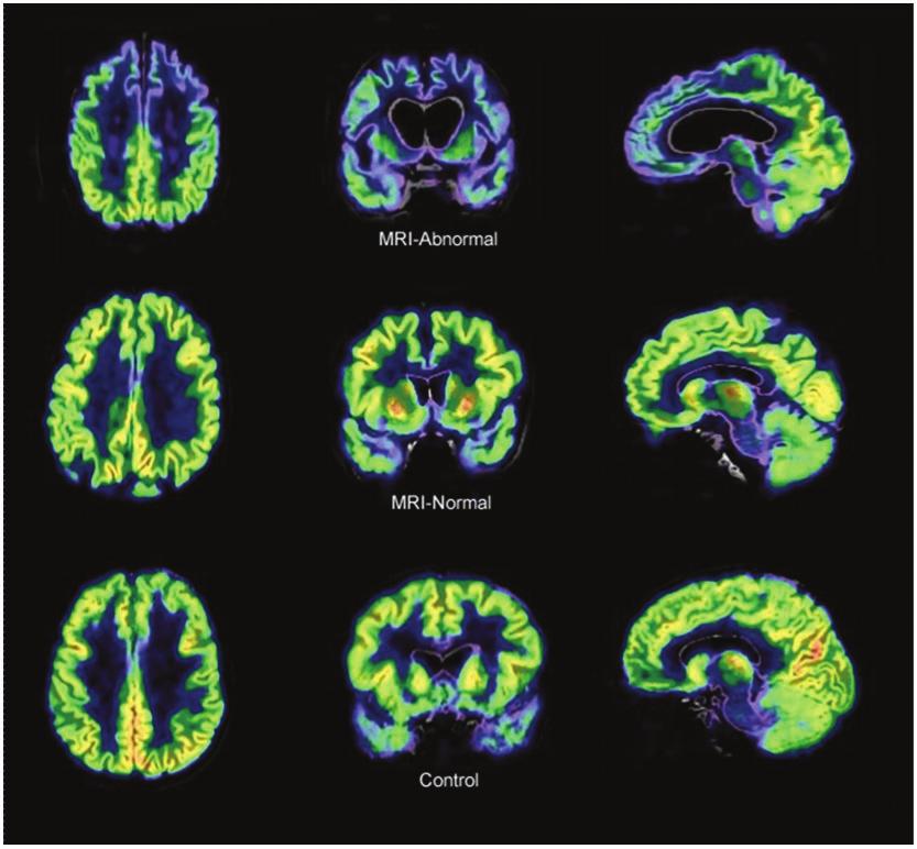 Frontotemporal dementia: refining the syndrome Brain 2009: 132; 2566 2578 2571 and the MRI-normal group (mean frontotemporal difference: P50.01).
