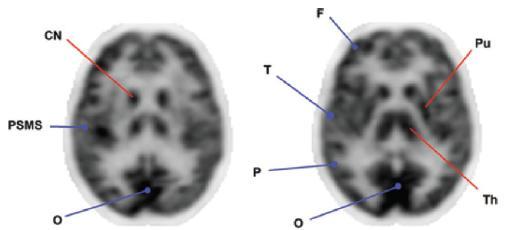 18 F-FDG brain PET Healthy subjects Cerebral cortex Basal ganglia Thalamus Cerebellum Subcortical putamen, caudate nucleus, thalamus High uptake in the cortical grey matter Lower uptake in white