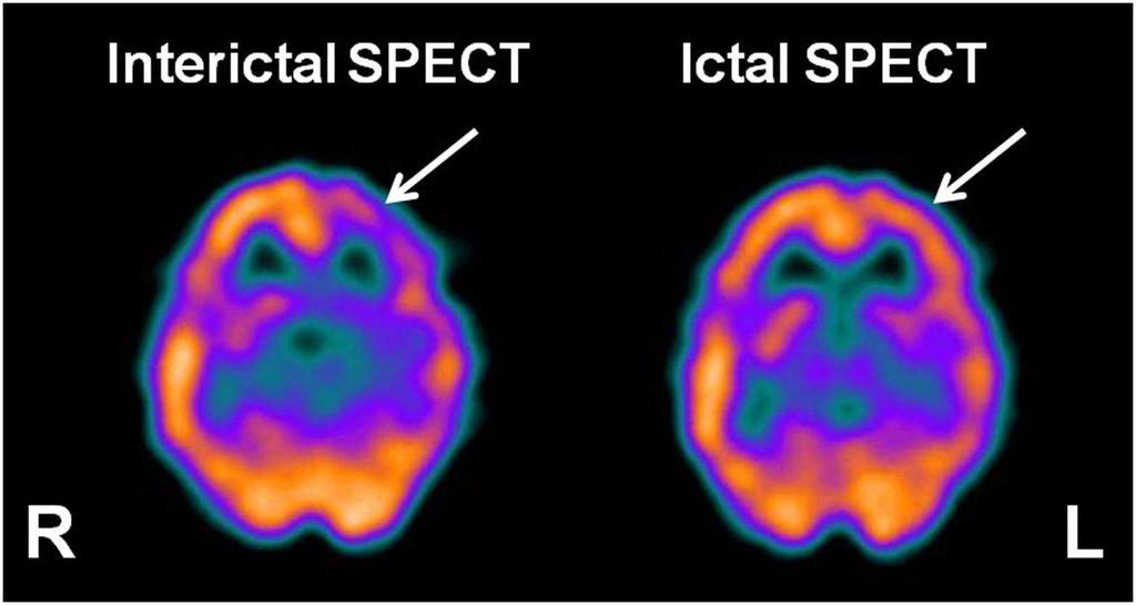 Epilepsy imaging Interictal 99m Tc-ECD SPECT (left image) showing the usual hypoperfusion in presumed epileptogenic focus (arrow)
