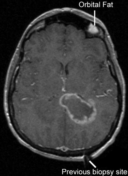 metastases T1 MR 18 F Choline increased uptake corresponding to the region of ring enhancement on T1 MRI,
