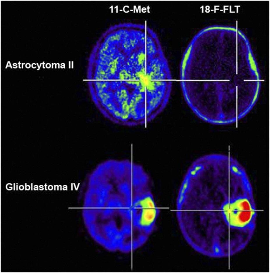 stable up to 75 min. Uptake of 11 C-MET and of 18 F-FLT in gliomas of low grade (top row) and high grade (bottom row).