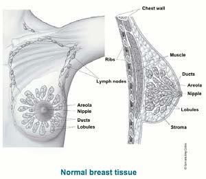 Know the Anatomy of the Breast To assign the correct summary stage code, registrars need to know the anatomy of the breast. Breast cancer is a malignant tumor that starts in the cells of the breast.