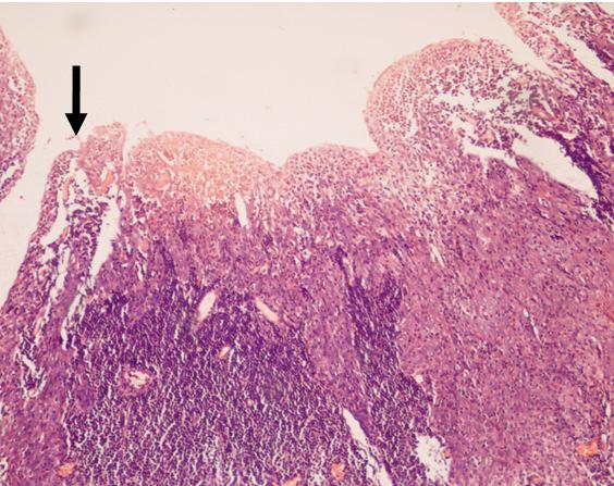SUBRHAMANYA et al. Brunei Int Med J. 2010; 6 (1): 58 Fig 3: Branchiogenic carcinoma with transformation (an essential feature) from benign to malignant epithelium (black arrow) (H&E, x10).