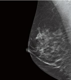 Dosimetry in Digital Breast Tomosynthesis employ multiple lines of response acquired over various angles similar acquisition and