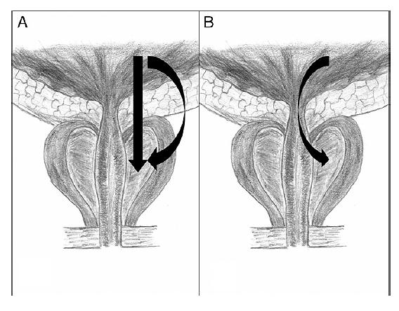 Background Documentation Figure 1. Prostatic invasion from urinary bladder cancer via direct transmural and extravesical route (A) and transurethral invasion (B).