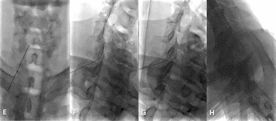 Using loss of resistance (LOR), when the needle reached the epidural space, fluoroscopic image at posteroanterior (PA), contralateral oblique (CLO) 50 degrees, CLO 60 degrees, and lateral view was
