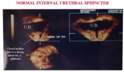 using vaginal and rectal probes, multifrequent, 5-7.5 MHz kretyz 530-3D in two groups of women. Twenty women not suffering from leakage of urine on sudden increase of abdominal pressure e.g., on coughing, sneezing, laughing or jumping, were examined clinically and by 3D U/S.
