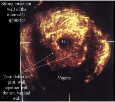 constituents of a thick wall of the internal urethral sphincter consistent with the histological picture described.