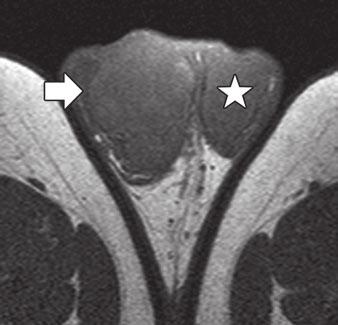 MRI of Testicular Neoplasms Subjects and Methods Forty patients were prospectively enrolled in this study, which was approved by the institutional review board of our hospital.