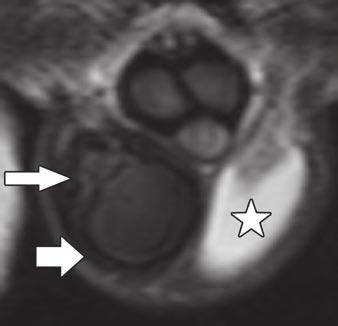 , Transverse contrast-enhanced T1-weighted image shows no lesion enhancement (arrow), confirming benign diagnosis. the testicular tunicae were assessed as intact at imaging (Figs.