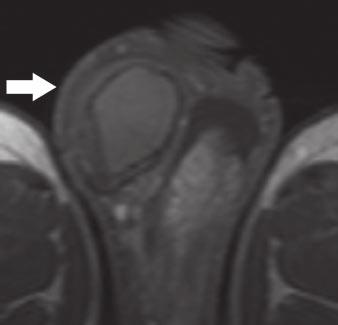 In one case, the tumor was falsely characterized as T2 owing to inability at MRI to recognize intact testicular tunicae in the vicinity of the neoplasm.