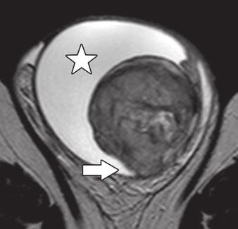 MRI of Testicular Neoplasms TLE 3: MRI Findings in Diagnosis of Malignant Versus enign Testicular Masses: Signal Intensity of Lesion ompared With That of Normal Testicular Parenchyma Lesion signal