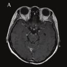Won-Young Park, Intrathecal Therapy for Leptomeningeal Metastases A B C Fig. 2. Case 2 contrast-enhanced T1-weighted brain magnetic resonance image (MRI).