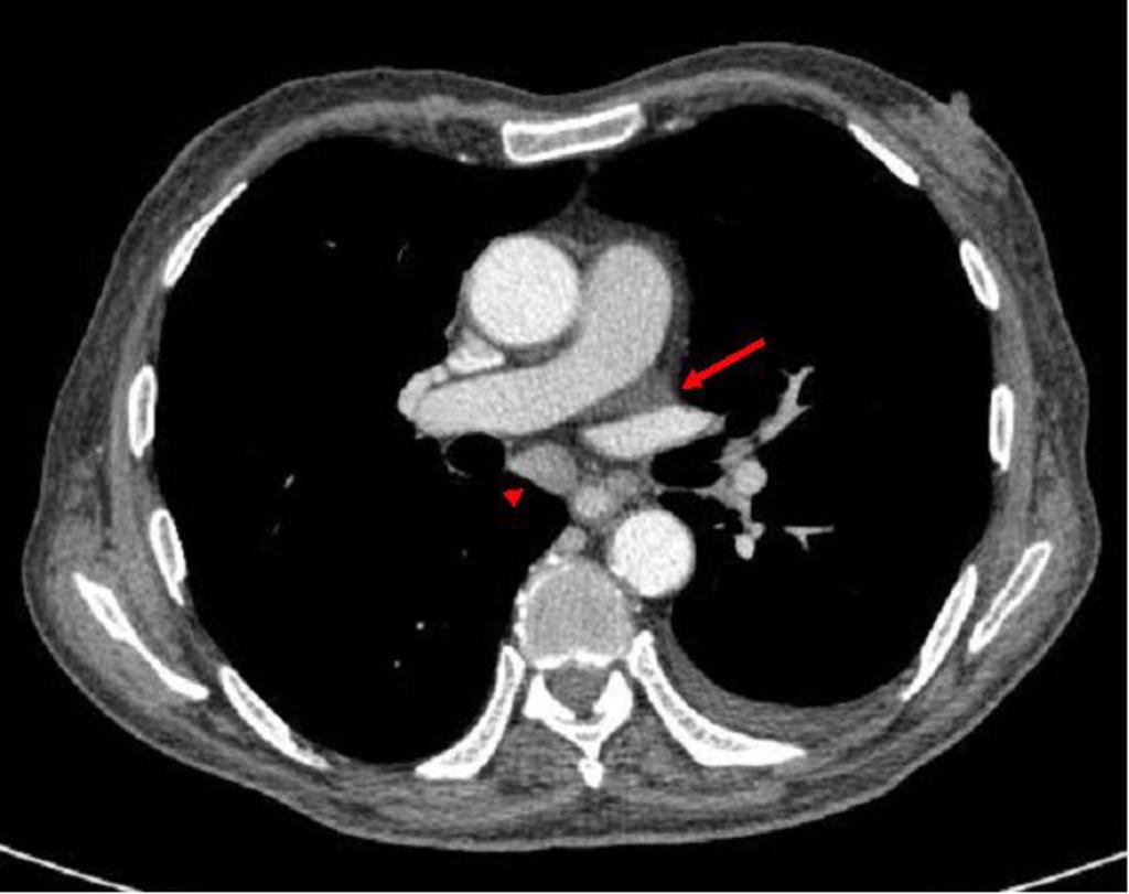 Fig. 9: Fluid in the left pulmonic recess (long arrow).