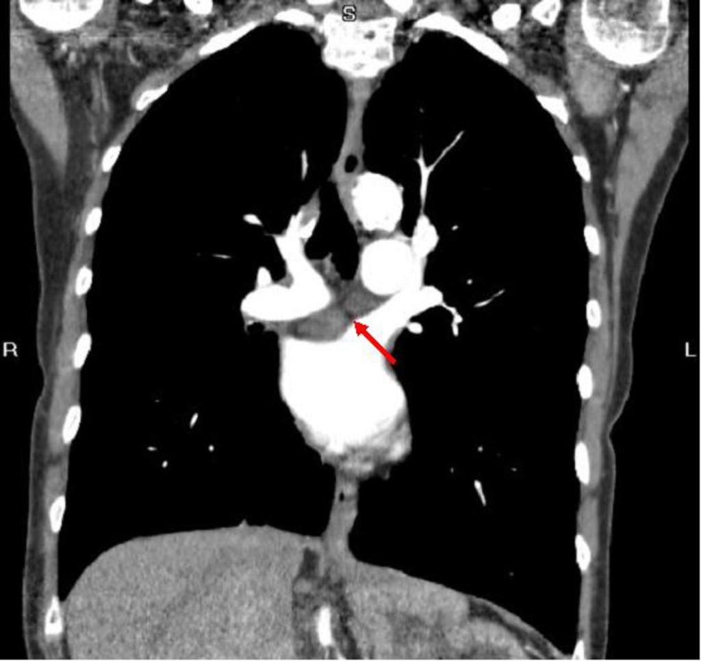 Fig. 11: Coronal reformatted images demonstrating pericardial