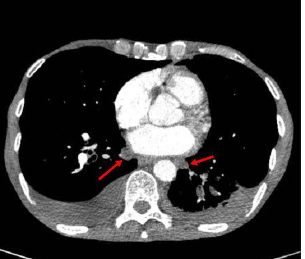 lateral extension of the transverse sinus lying inferior to the right and left pulmonary arteries respectively (Fig 8,9).