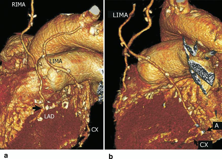 Therefore, the patient was treated with totally endoscopic single left internal mammary artery (LIMA) grafting to the LAD and the simultaneous implantation of a cypher stent (Cordis; Johnson &