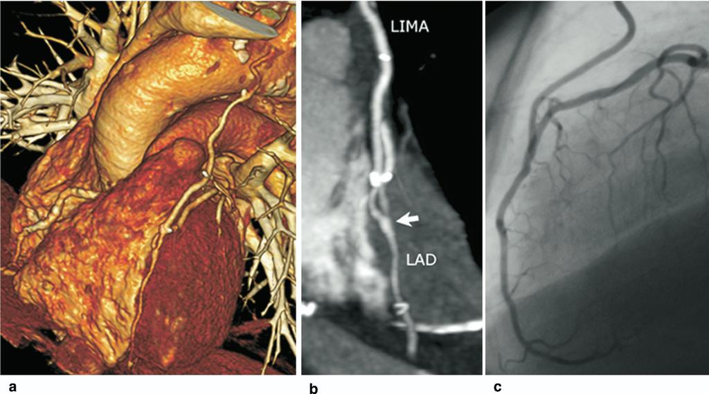 SCHACHNER ET AL INTROPERATIVE GRAFT ANGIOGRAPHY 1365 Ann Thorac Surg 2007;83:1361 7 Fig 4. Single-vessel totally endoscopic coronary artery bypass graft.