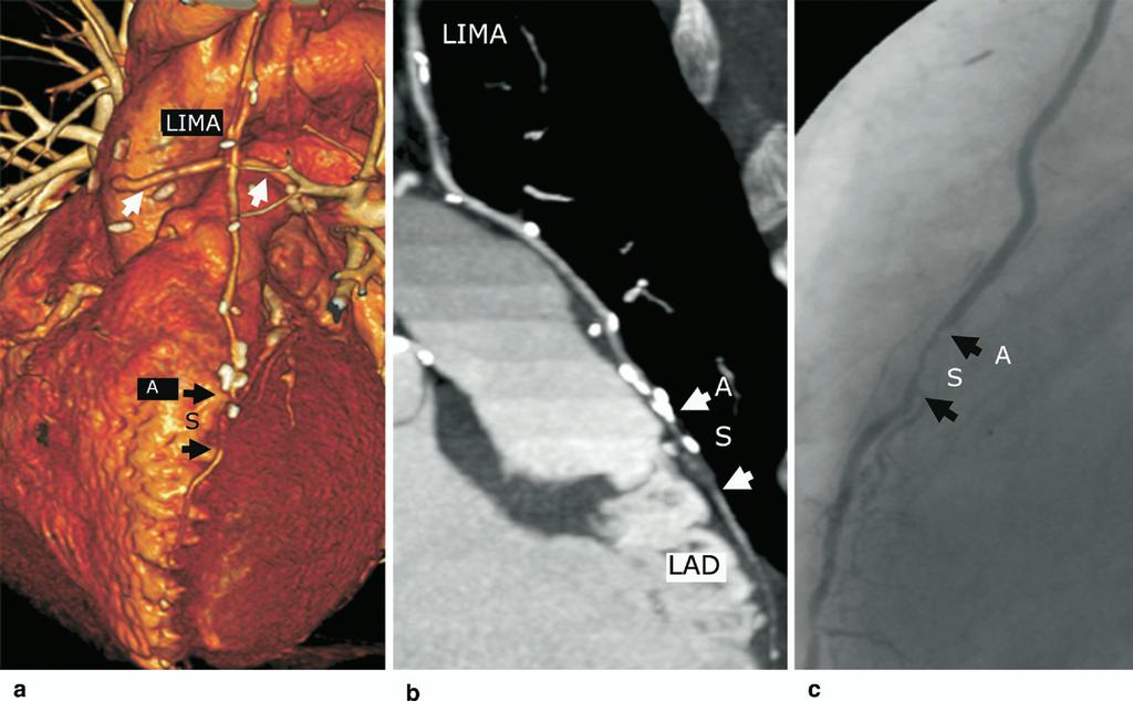 1366 SCHACHNER ET AL Ann Thorac Surg INTROPERATIVE GRAFT ANGIOGRAPHY 2007;83:1361 7 Fig 5. Single-vessel totally endoscopic coronary artery bypass graft.