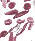 Sickle Cell Anemia Sickle Cell Anemia is a Genetic Disease Affecting