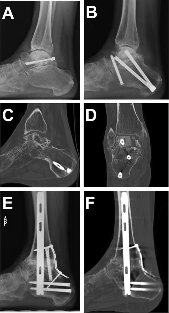 Case 2 Example: Traumatic - 35 yo female - Traumatic AVN secondary to prior talar neck fracture - Surgery: Subtalar fusion performed with two 7.5mm cannulated screws, a single 5.