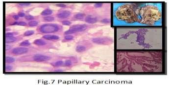 References []. Richa S, Mathur DR. Diagnostic accuracy of fine needle aspiration cytology (FNAC) of the thyroid gland lesions. Int J Health Sci Res 202;2:-7. [2]. Cibas ES and Ali SZ.