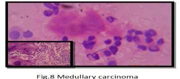 The role of Thyroid fine needle aspiration cytology and the Bethesda system for reporting Thyroid cytopathology. Diagnostic Histopathology 20; 7: 95-05. [4].