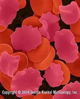 Crenated red blood cells in hypertonic salt