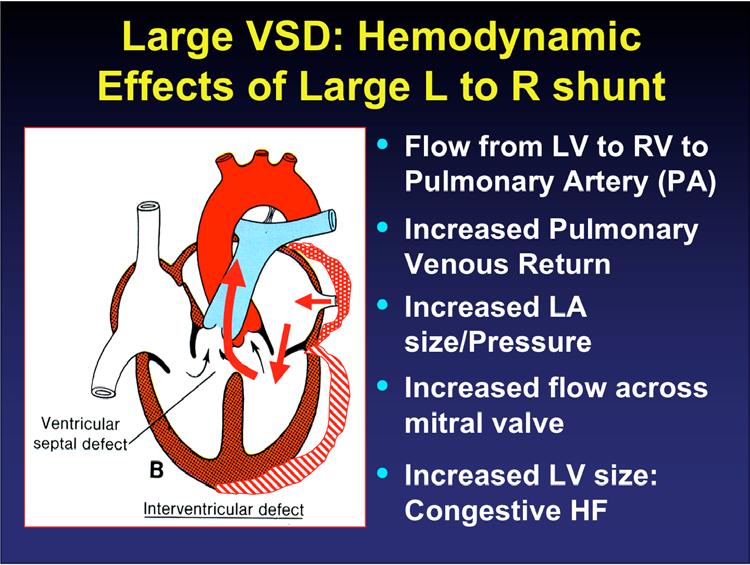 Large VSD: Hemodynamic Effects of Large L to R shunt Flow from LV to RV to Pulmonary Artery (PA) Increased Pulmonary Venous Return Increased LA size/pressure Increased flow across mitral valve