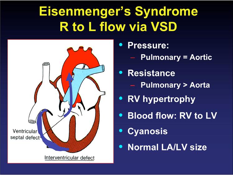 Eisenmenger s Syndrome R to L flow via VSD Pressure: Pulmonary = Aortic Resistance Pulmonary > Aorta RV hypertrophy Blood flow: RV to LV Cyanosis Normal LA/LV size Clinical Picture: Eisenmenger s