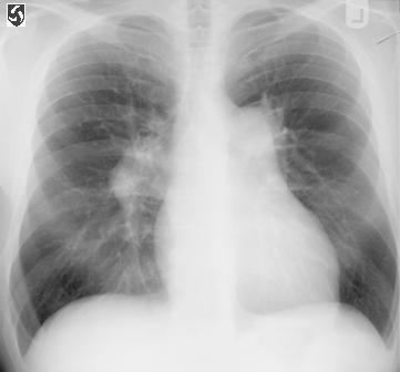 Chest X-Ray: Eisenmenger Syndrome Management Do NOT close