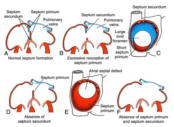 Atrial Septal Defect (ASD) Manifestations of ASD L to R shunt