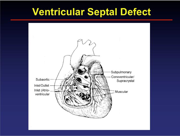 Endocardial Cushion Defect (ECD) Left ventricle to Right ventricle Left atrium to