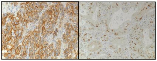560 BAR-SELA et al: HER2 AND CYCLIN D1 EXPRESSION adenocarcinoma.
