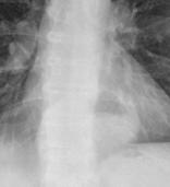 level overlapped with cardiac shadow (black arrow); Barium meal AP and right oblique: GEJ (green